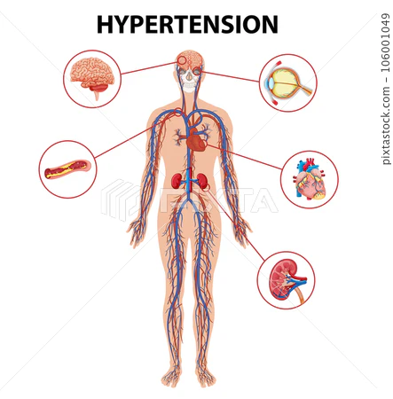 Órganos afectados por la hipertensión